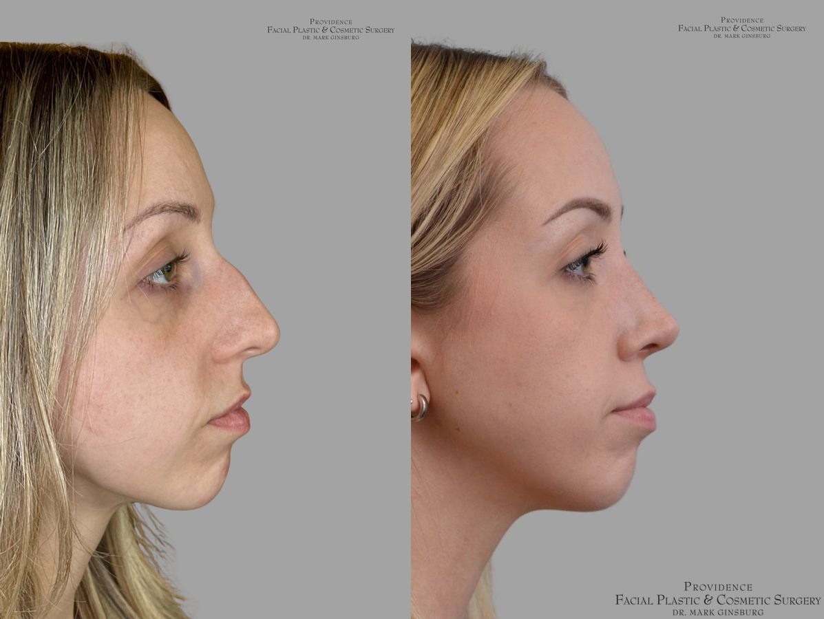 Before and after Thin Skin Rhinoplasty case 31659 - Angle 3