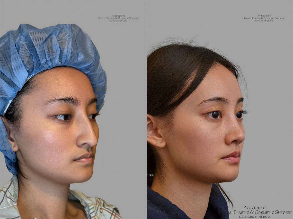 Before and after Primary Rhinoplasty case 31657 - Angle 2
