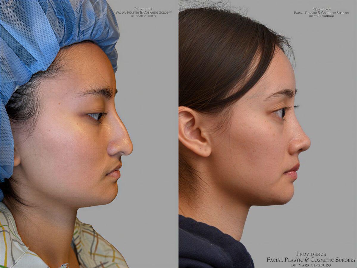 Before and after Primary Rhinoplasty case 31657 - Angle 3