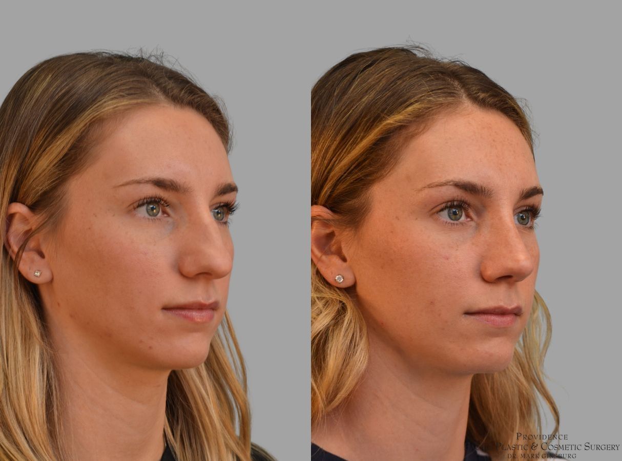 Before and after Primary Rhinoplasty case 43679 - Angle 4