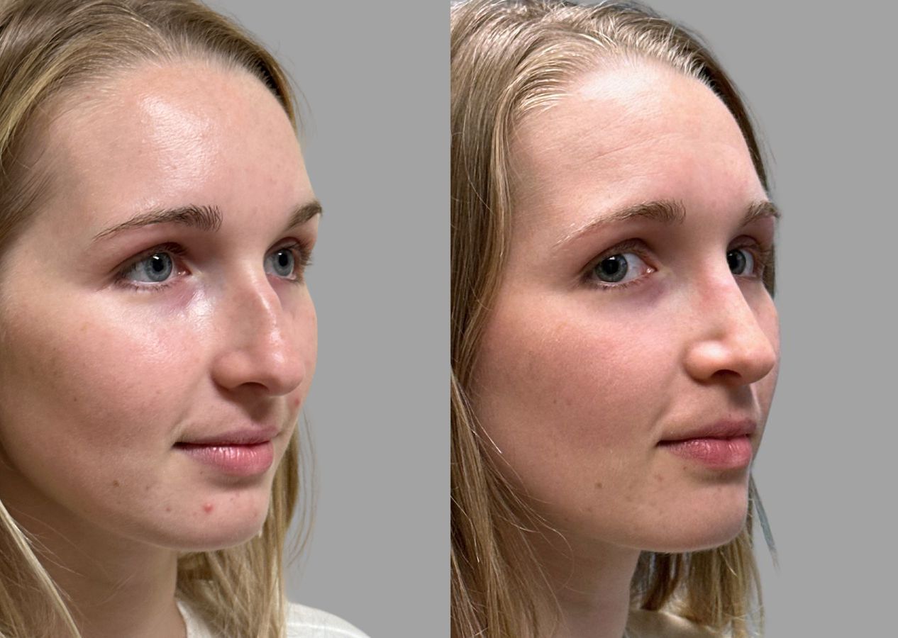 Before and after Primary Rhinoplasty case 31634 - Angle 2