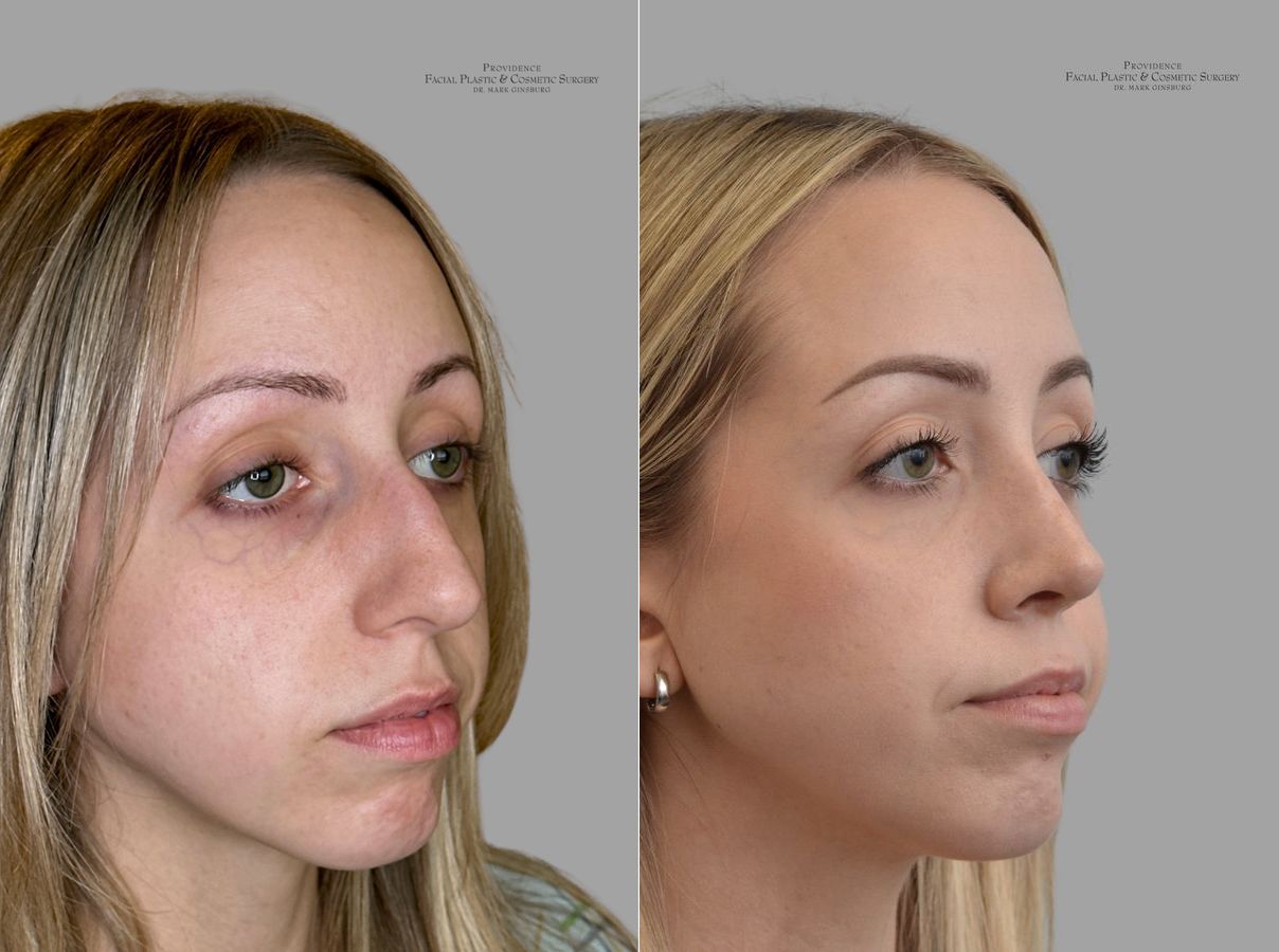 Before and after Primary Rhinoplasty case 31659 - Angle 2
