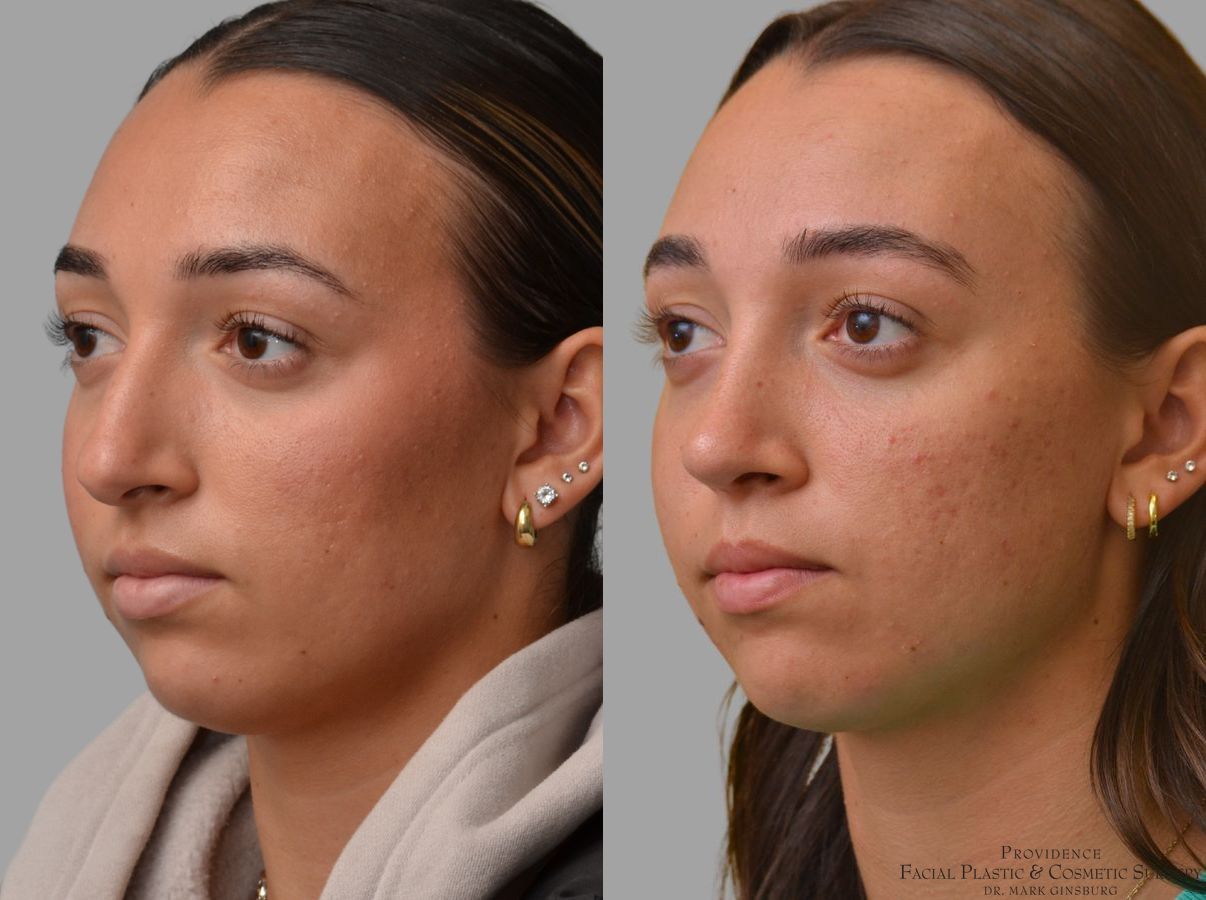 Before and after Primary Rhinoplasty case 49953 - Angle 2