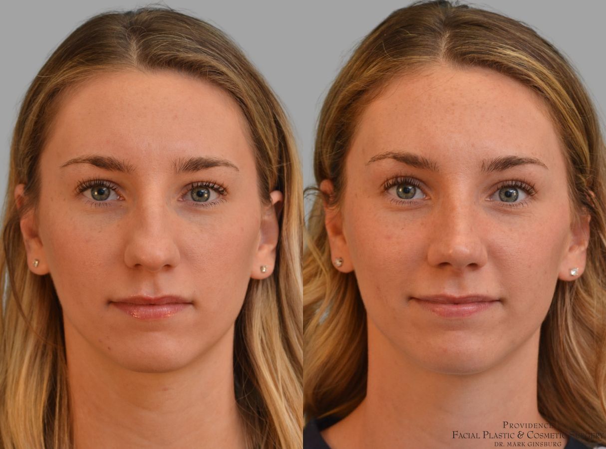 Before and after Primary Rhinoplasty case 43679 - Angle 3