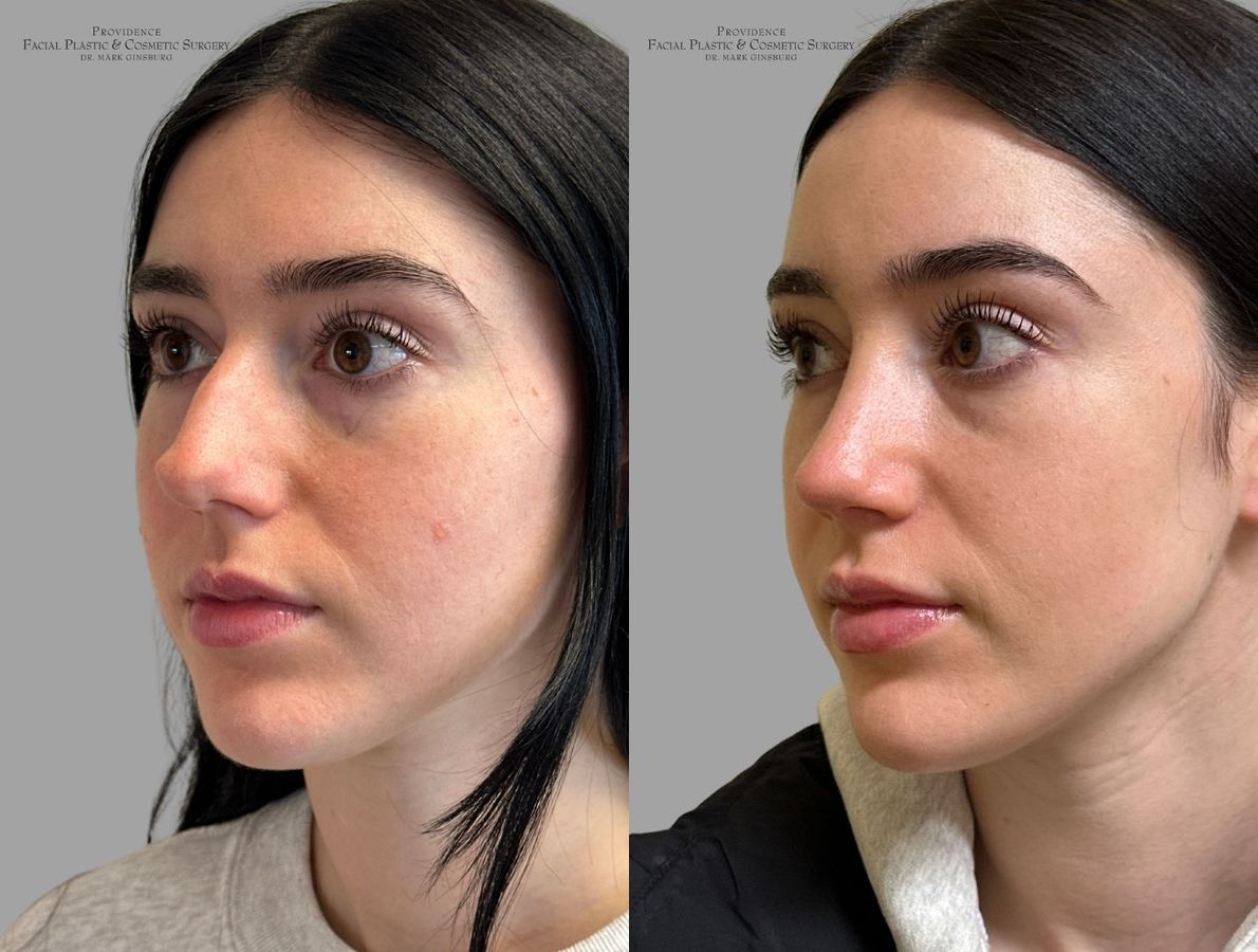 Before and after Primary Rhinoplasty case 31637 - Angle 5