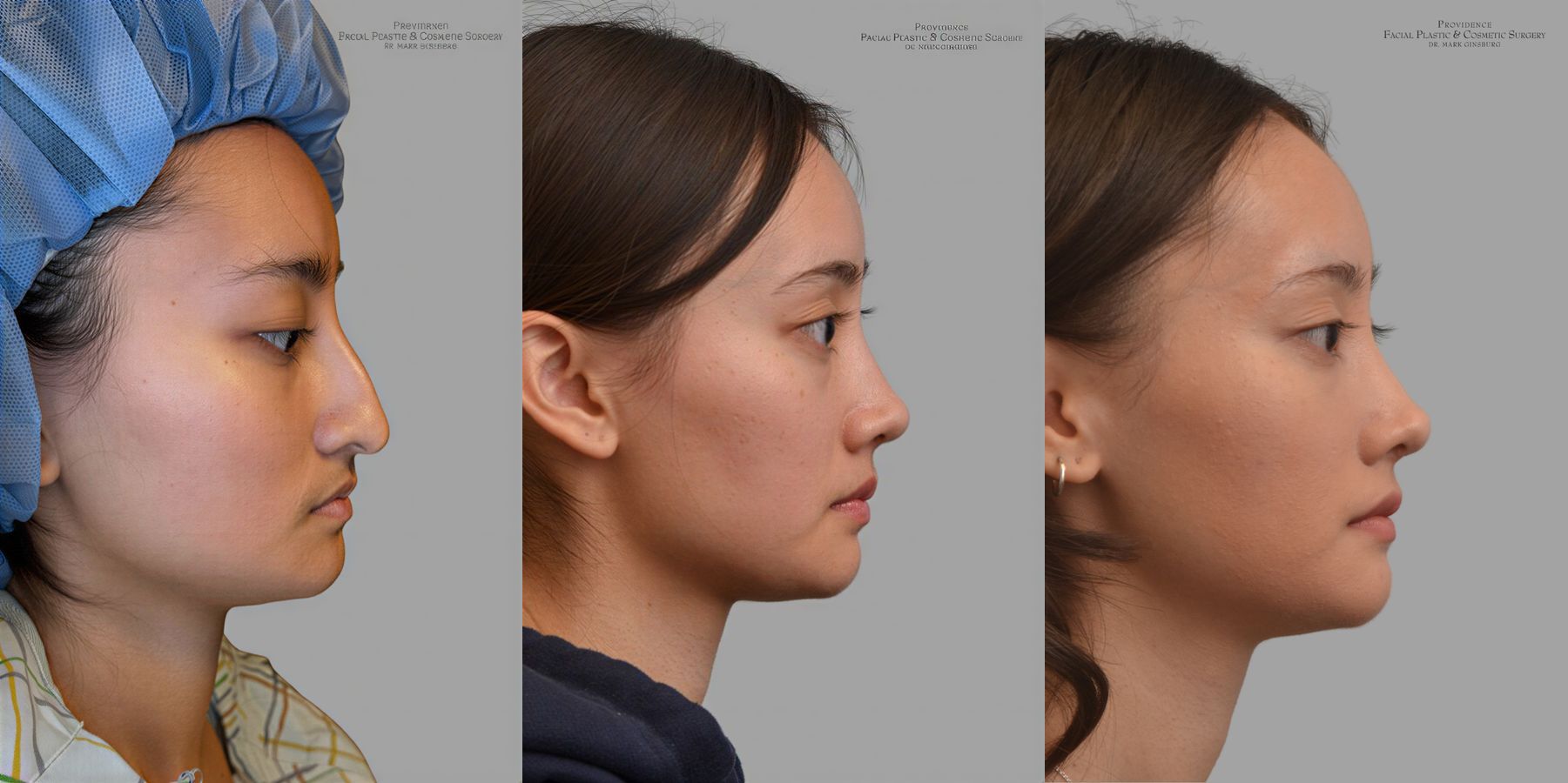 Before and after Ethnic Rhinoplasty case 31657 - Angle 3