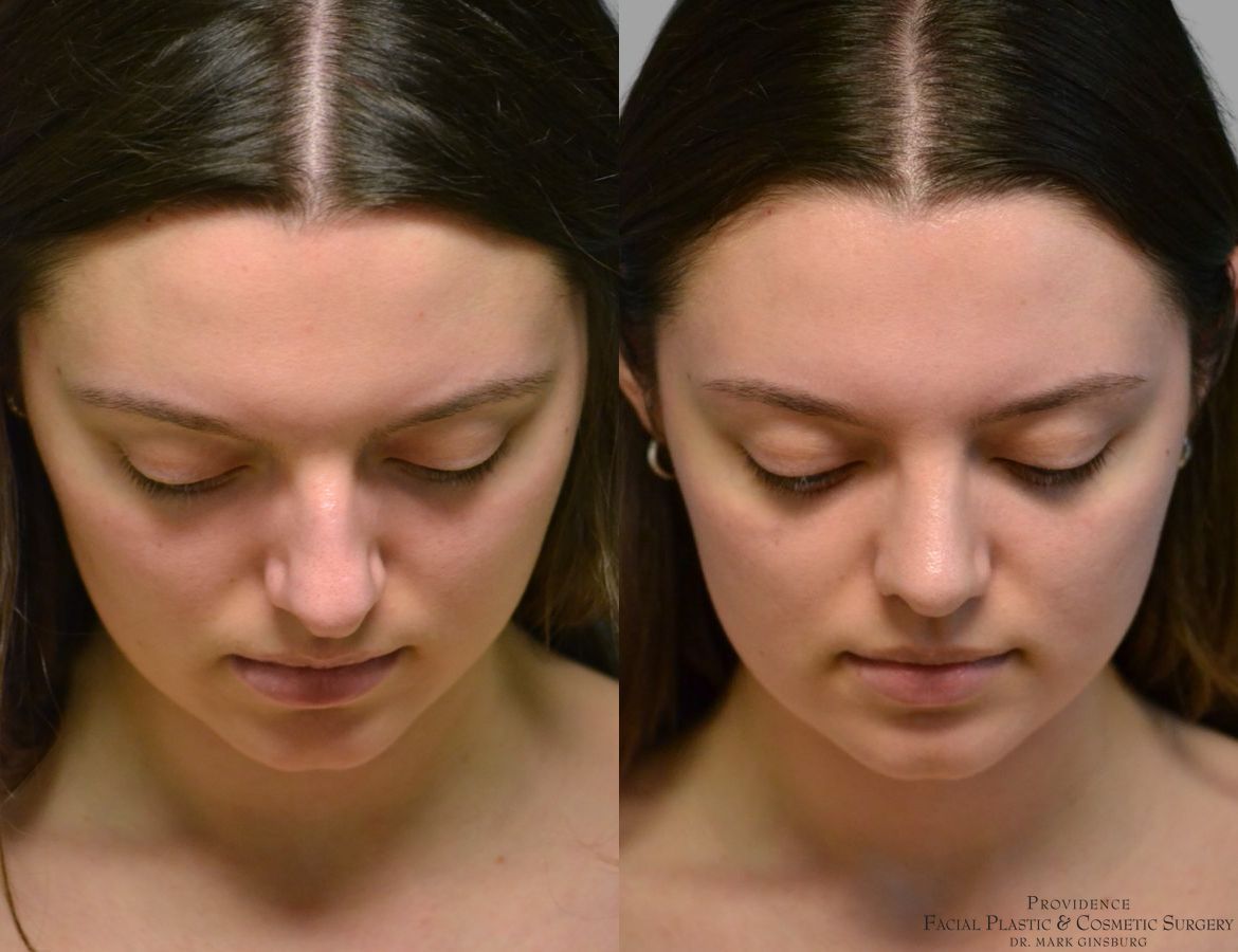 Before and after Primary Rhinoplasty case 49488 - Angle 6