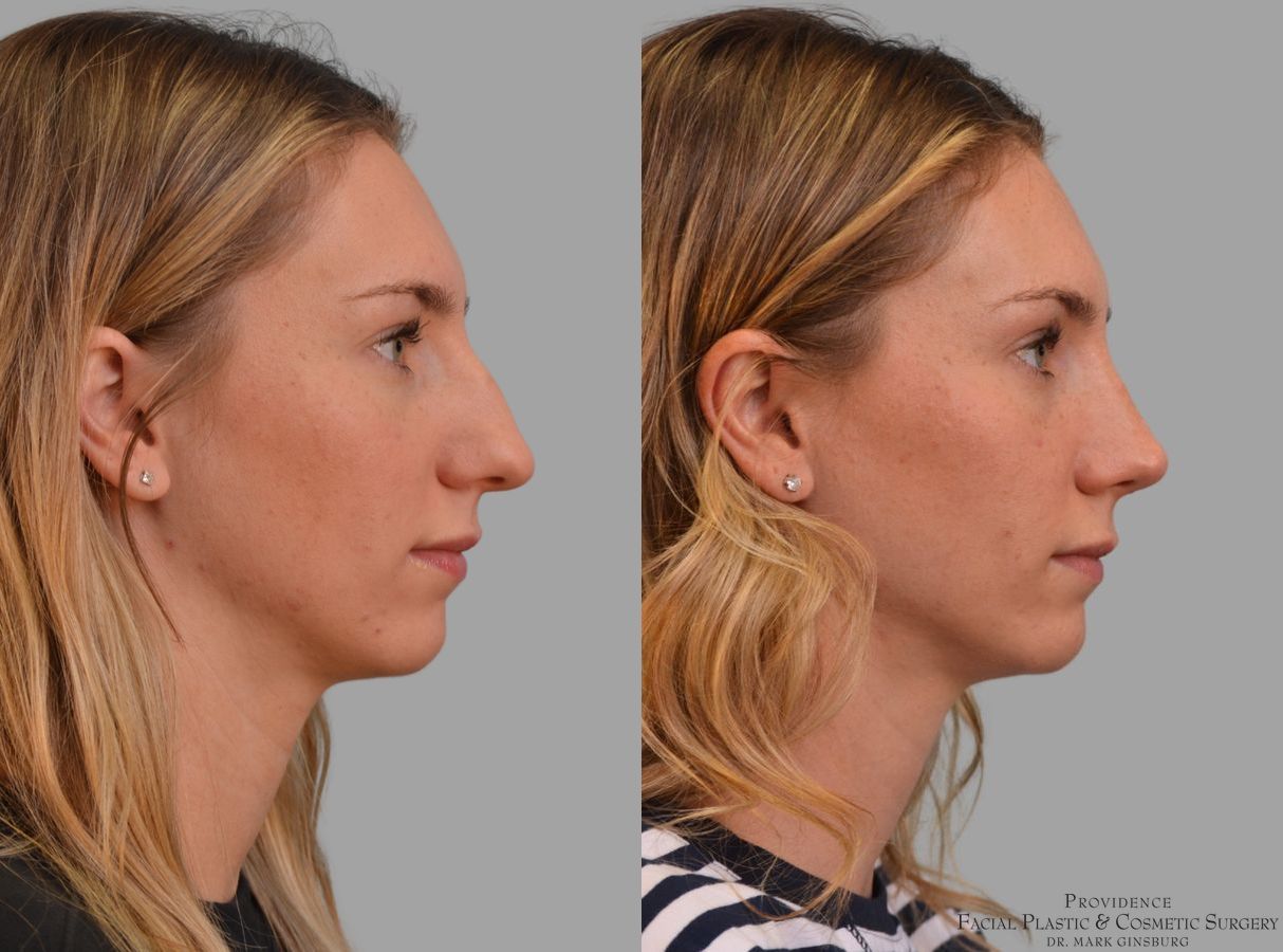 Before and after Primary Rhinoplasty case 43679 - Angle 5