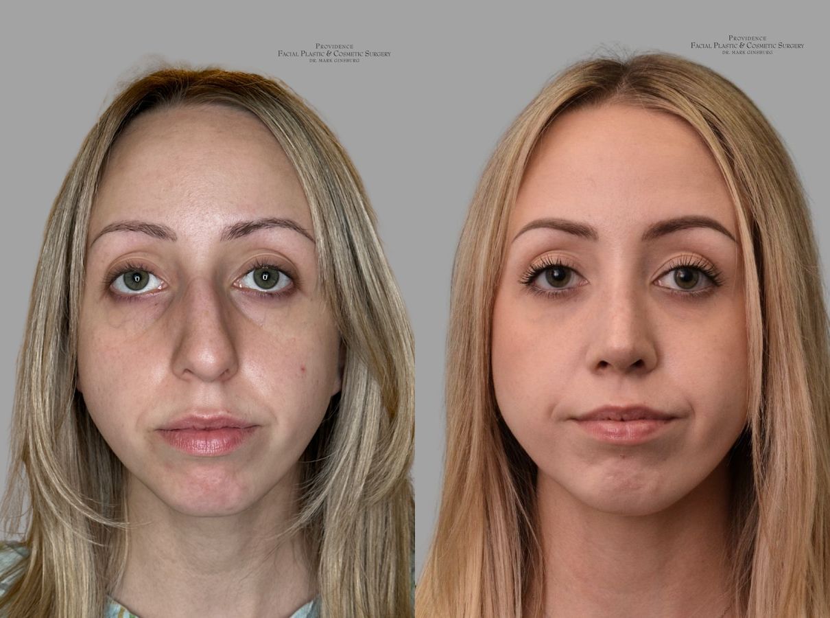 Before and after Primary Rhinoplasty case 31659