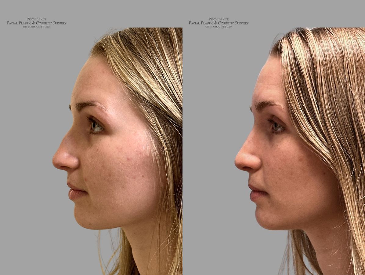 Before and after Primary Rhinoplasty case 31634 - Angle 6