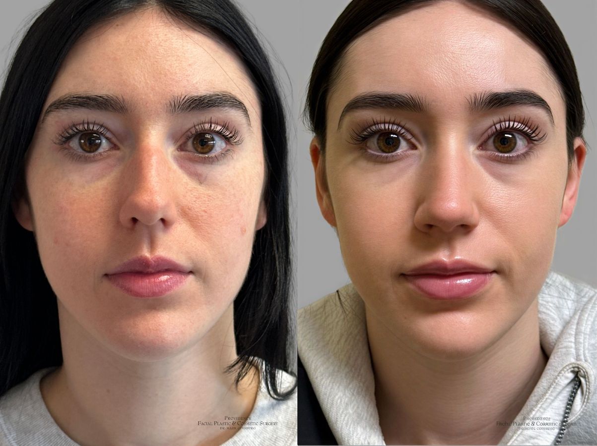 Before and after Primary Rhinoplasty case 31637