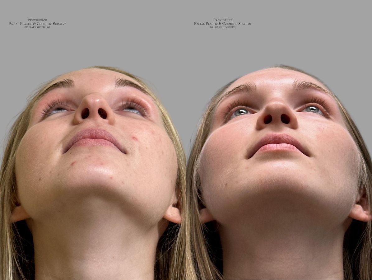 Before and after Primary Rhinoplasty case 31634 - Angle 4