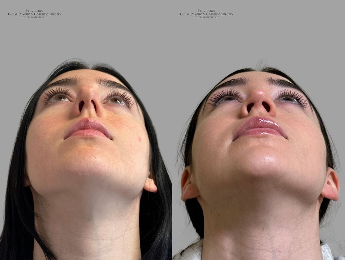 Before and after Primary Rhinoplasty case 31637 - Angle 2