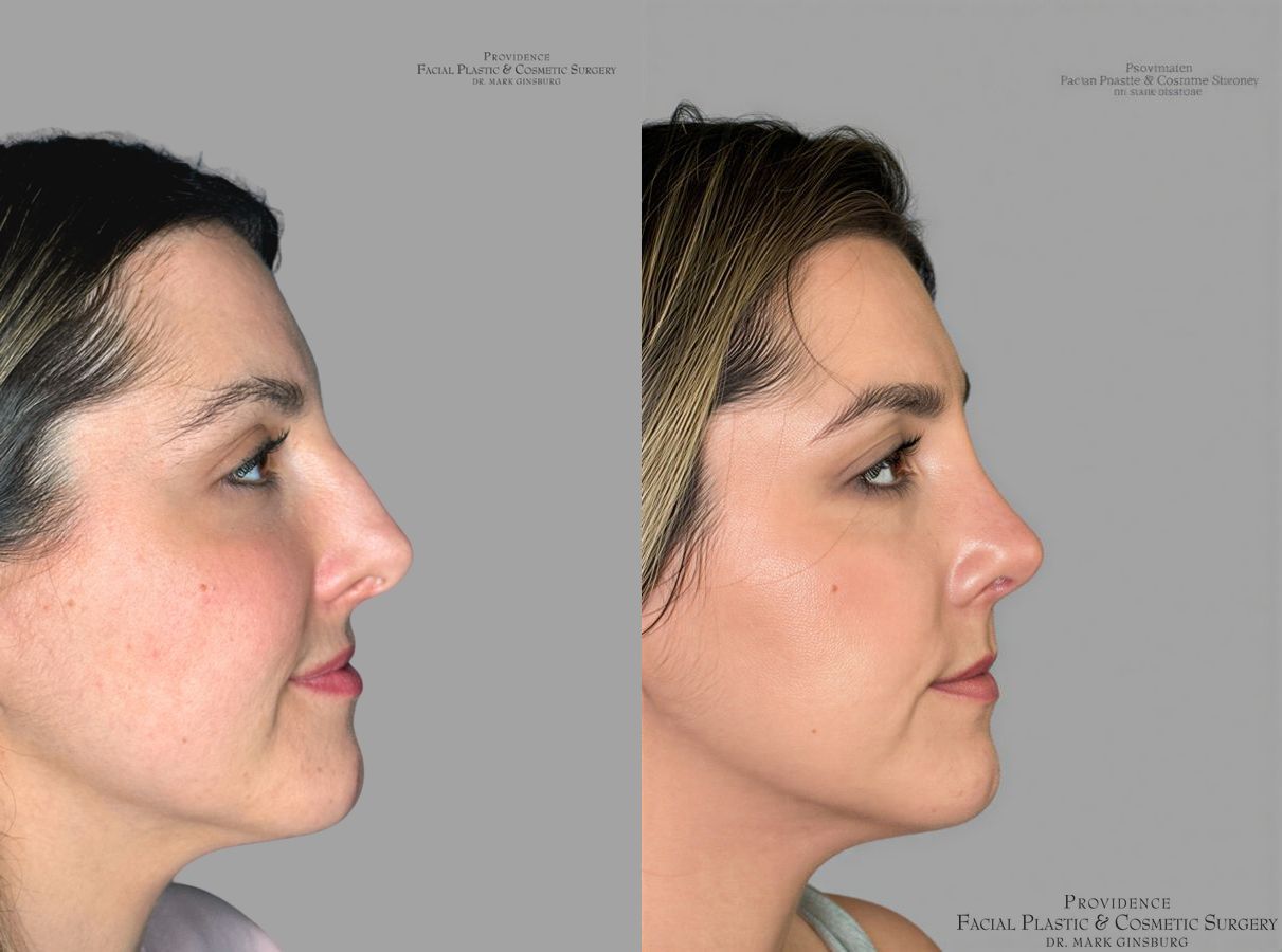 Before and after Primary Rhinoplasty case 31639 - Angle 3