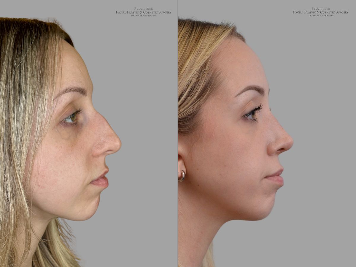 Before and after Primary Rhinoplasty case 31659 - Angle 3