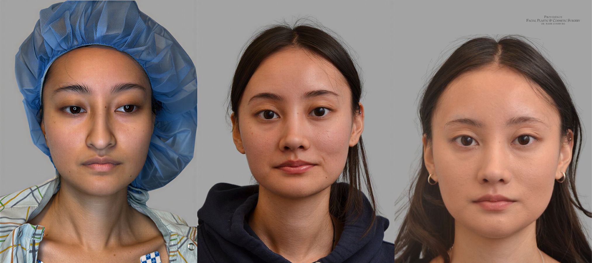 Before and after Ethnic Rhinoplasty case 31657