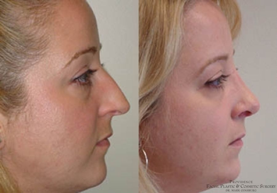 Before and after Primary Rhinoplasty case 31621 - Angle 2