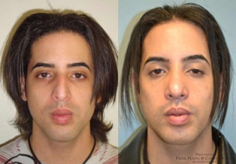 Before and after Male Rhinoplasty case 31602