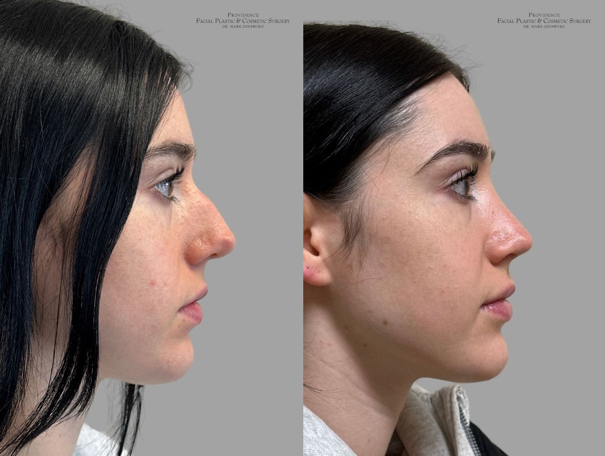 Before and after Primary Rhinoplasty case 31637 - Angle 4