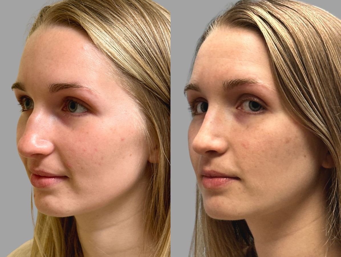 Before and after Primary Rhinoplasty case 31634 - Angle 5
