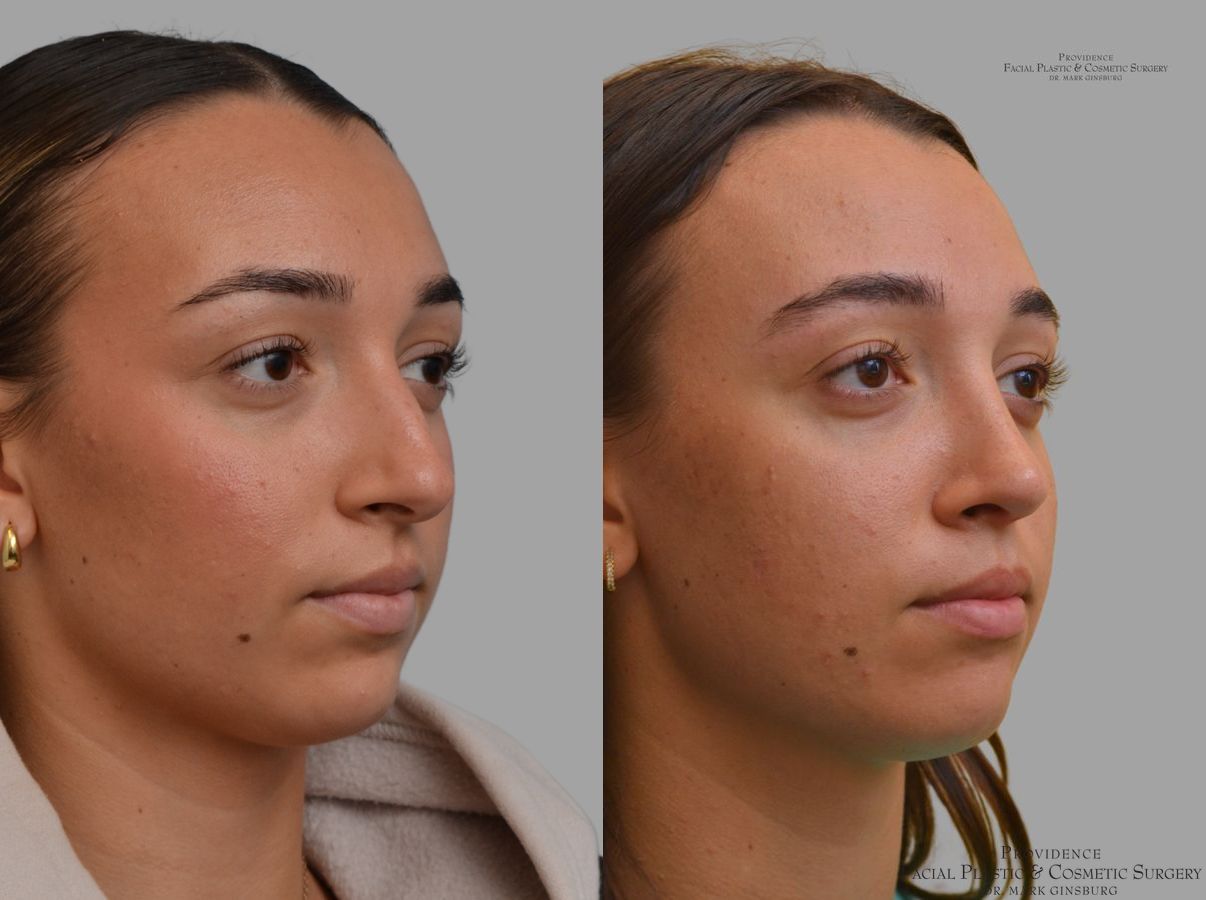 Before and after Primary Rhinoplasty case 49953 - Angle 4