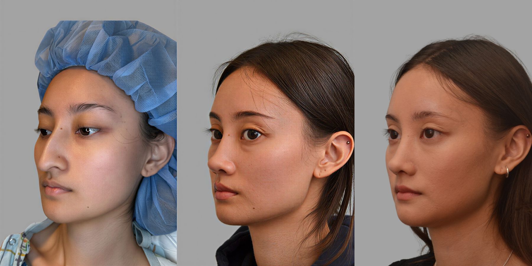Before and after Ethnic Rhinoplasty case 31657 - Angle 4