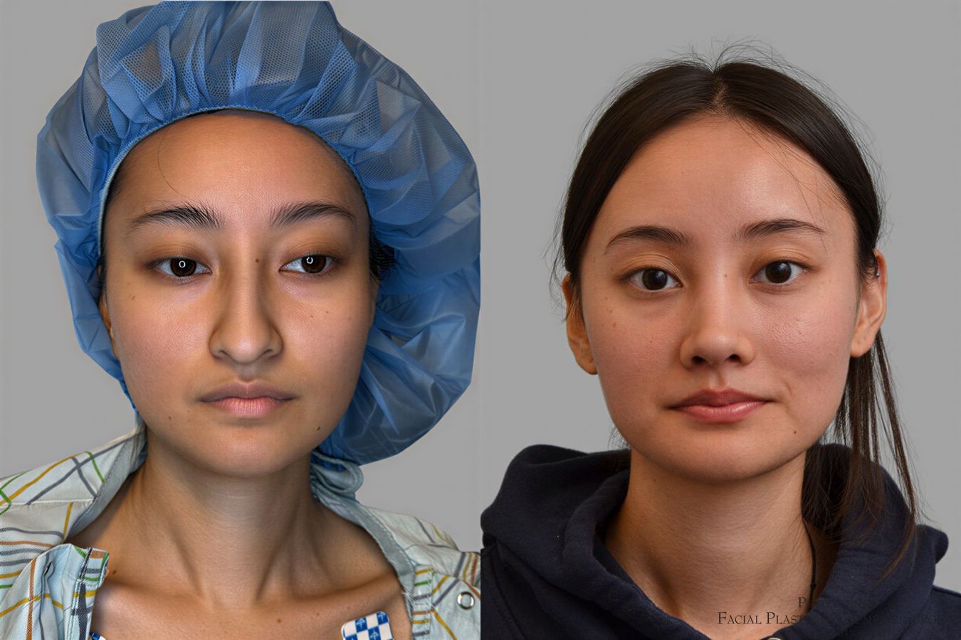 Before and after Primary Rhinoplasty case 31657