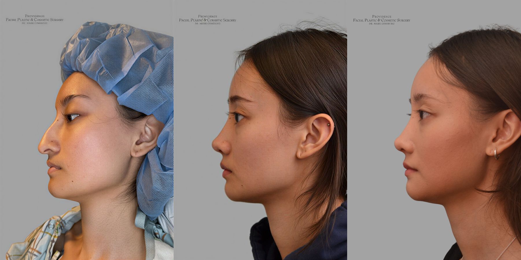 Before and after Ethnic Rhinoplasty case 31657 - Angle 5