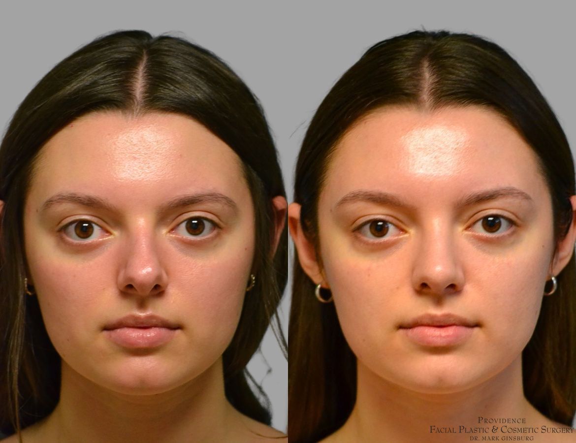 Before and after Primary Rhinoplasty case 49488 - Angle 3