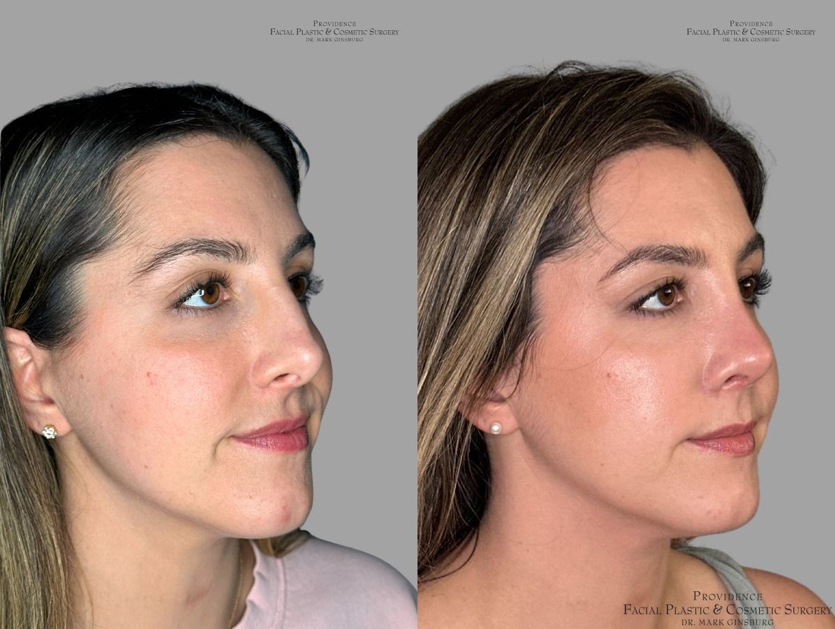Before and after Primary Rhinoplasty case 31639 - Angle 2