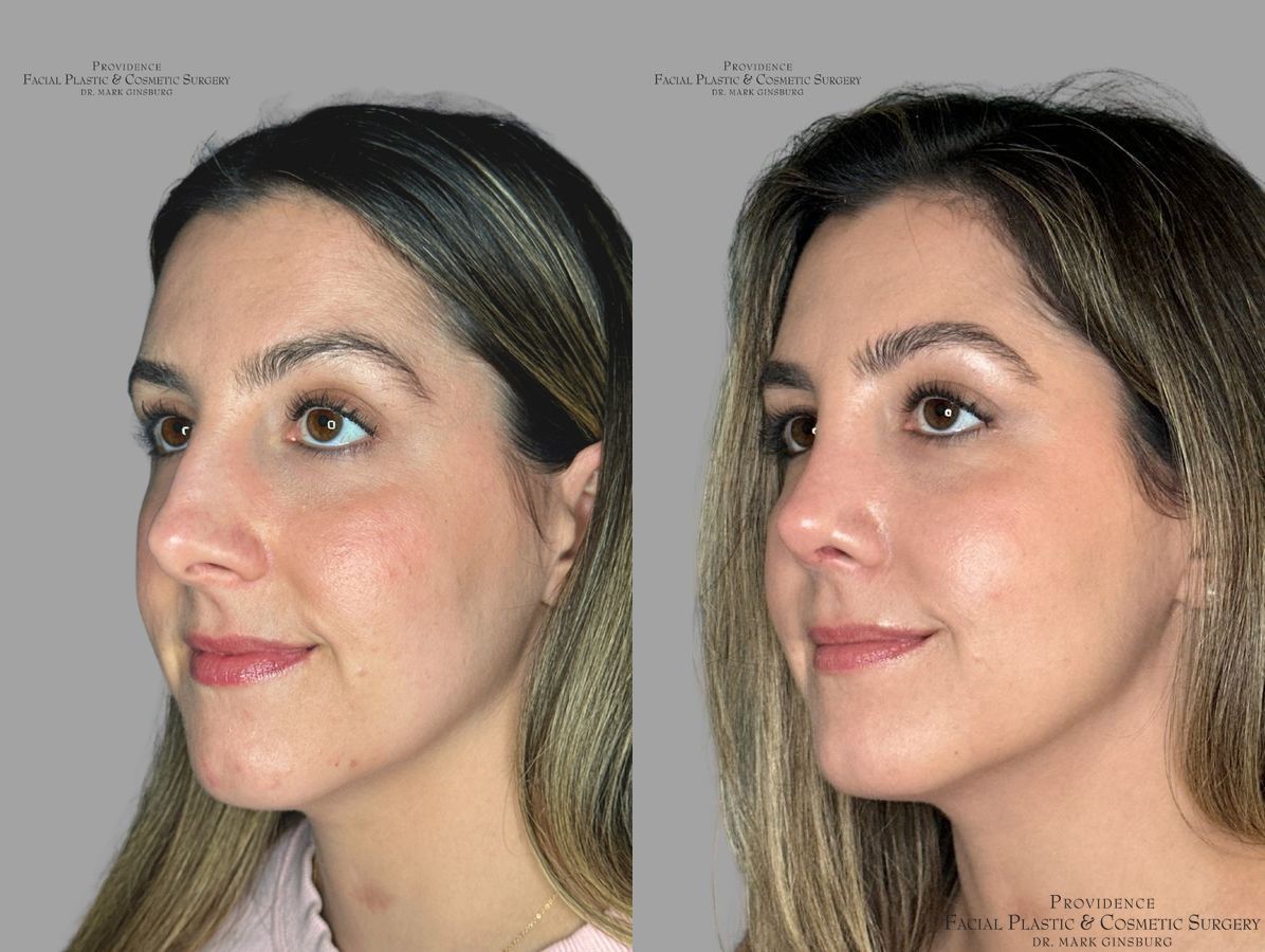 Before and after Primary Rhinoplasty case 31639 - Angle 4