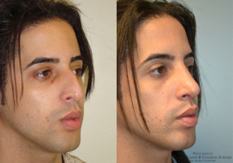 Before and after Primary Rhinoplasty case 31602 - Angle 3