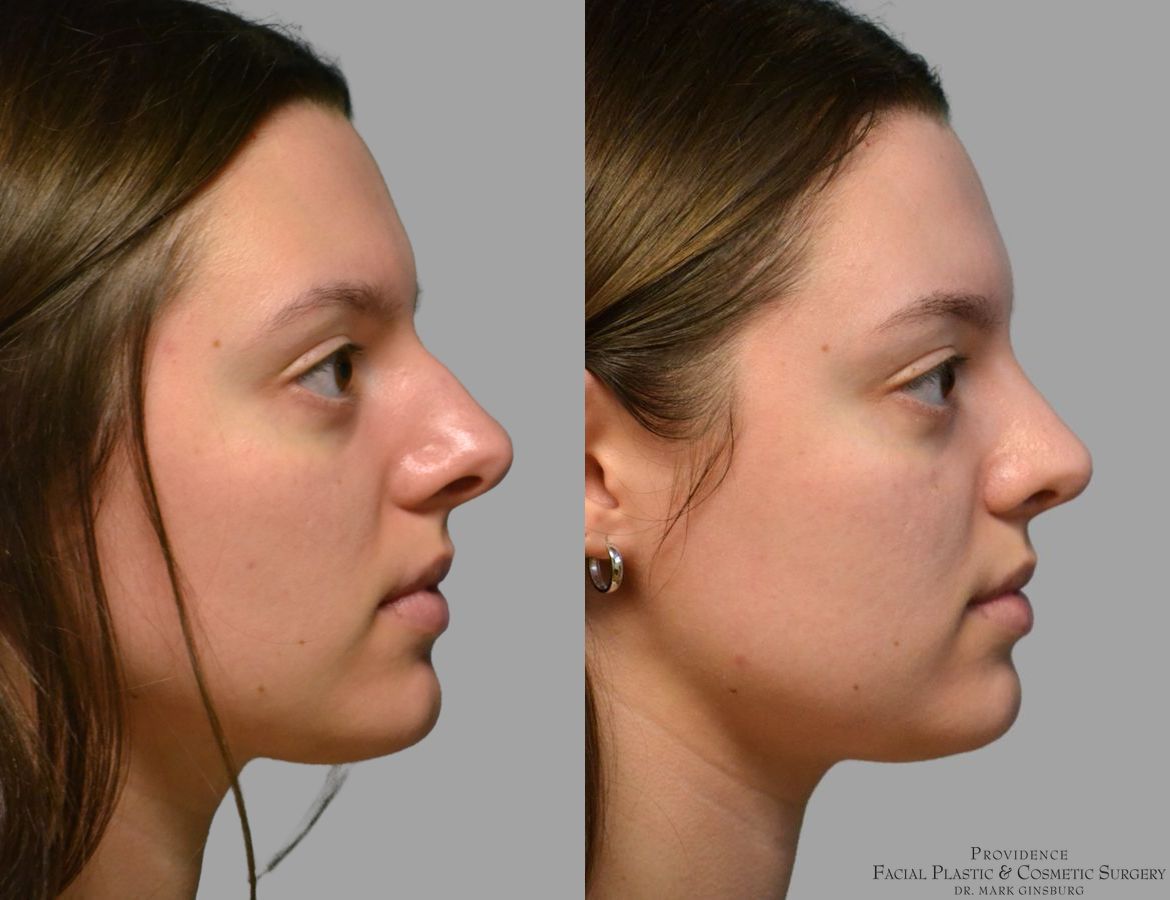 Before and after Primary Rhinoplasty case 49488 - Angle 5