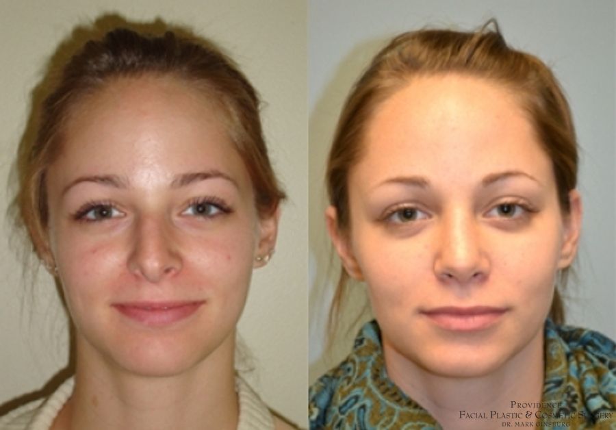 Before and after Primary Rhinoplasty case 31623