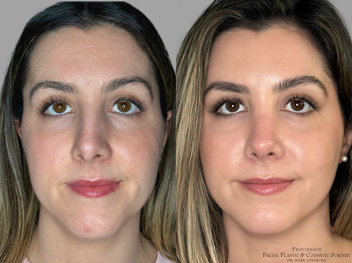 Before and after Primary Rhinoplasty case 31639
