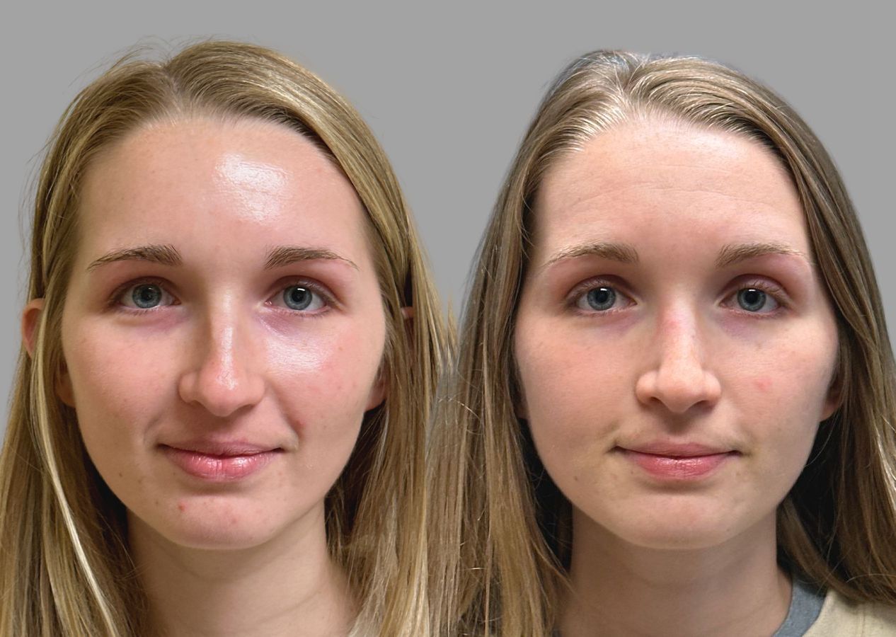 Before and after Primary Rhinoplasty case 31634