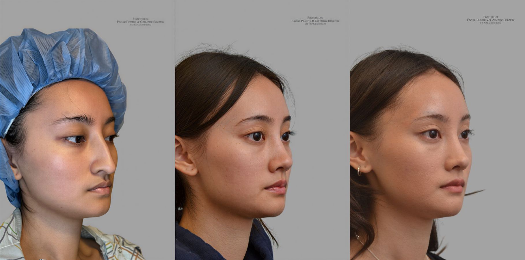 Before and after Ethnic Rhinoplasty case 31657 - Angle 2