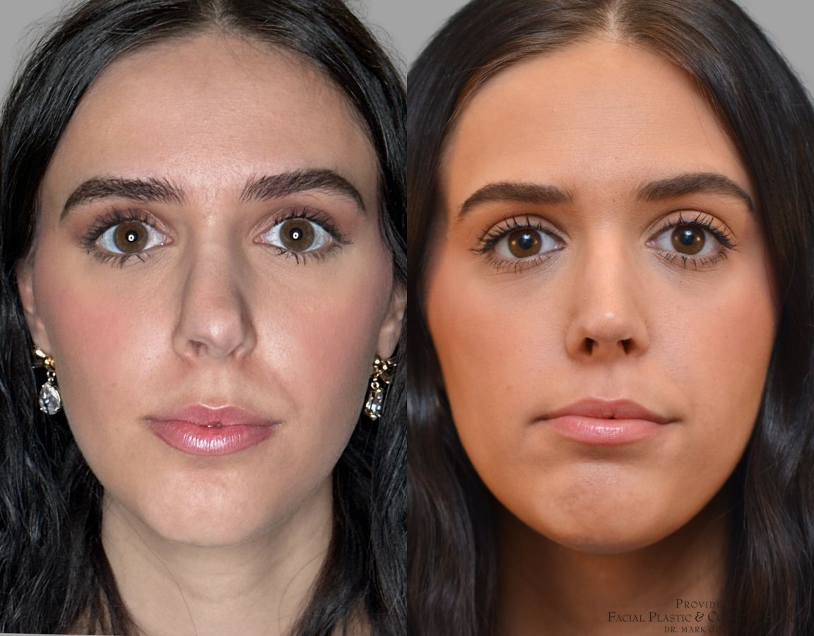 Before and after Revision Rhinoplasty case 43678 - Angle 3