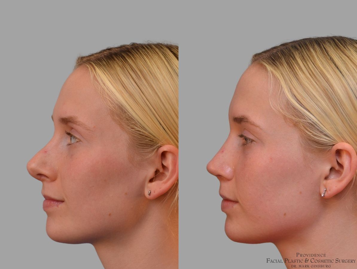 Before and after Revision Rhinoplasty case 41761