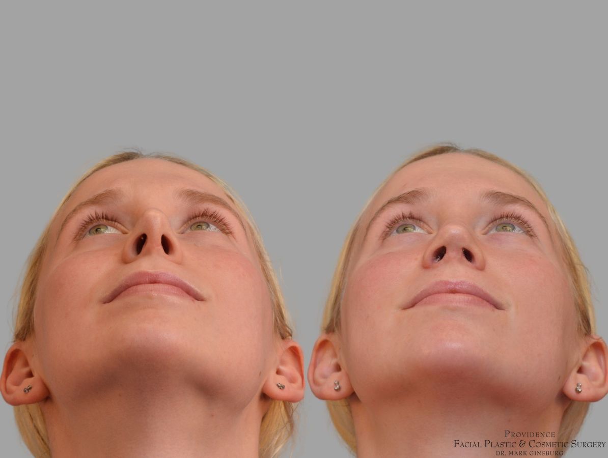 Before and after Revision Rhinoplasty case 41761 - Angle 6
