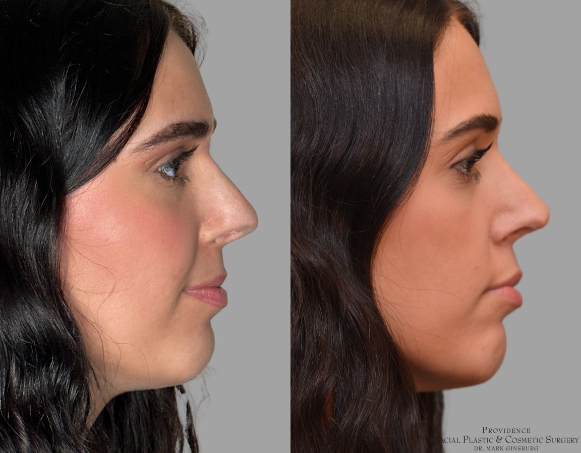 Before and after Revision Rhinoplasty case 43678 - Angle 5