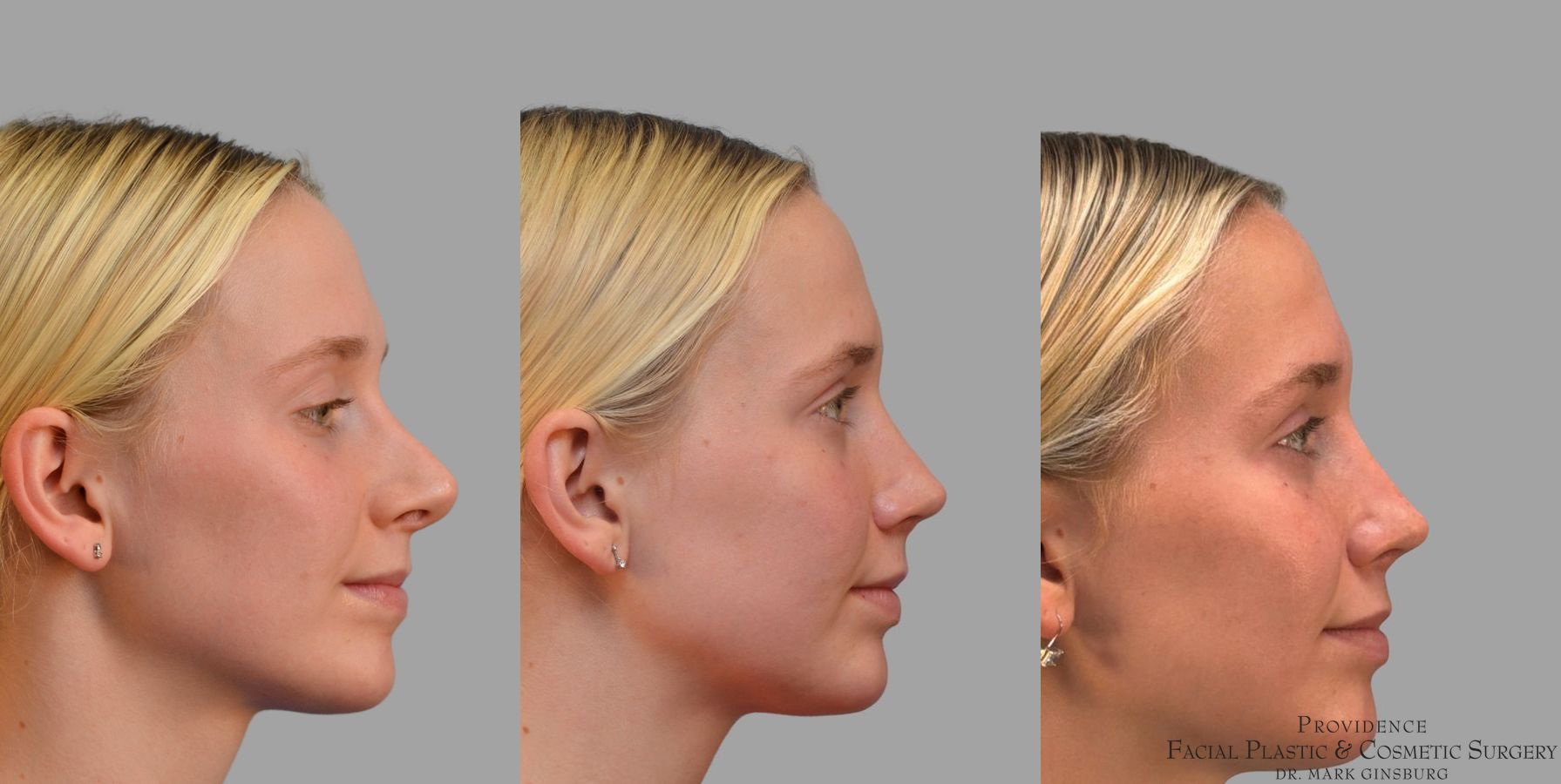 Before and after Revision Rhinoplasty case 41761 - Angle 5