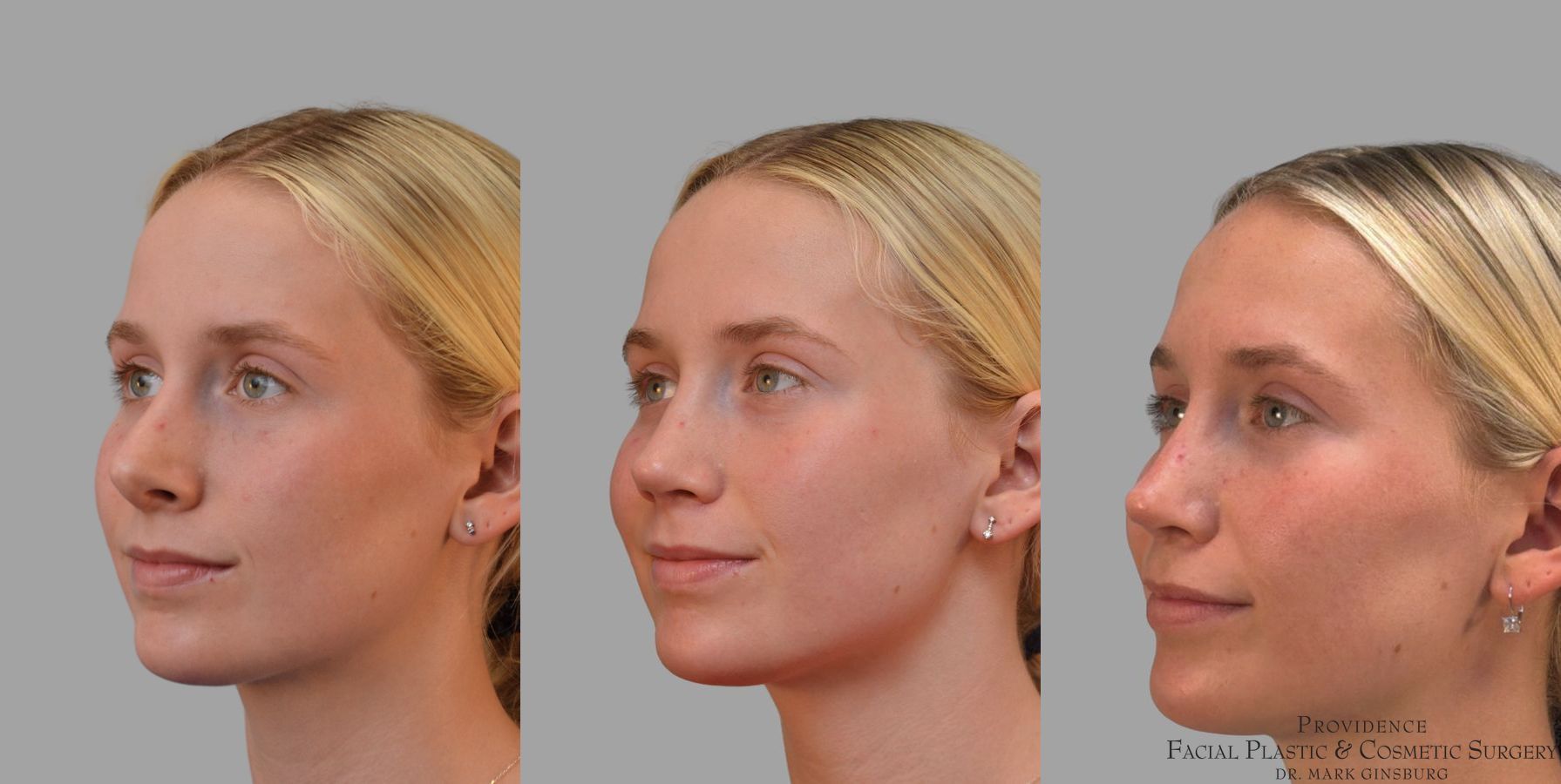 Before and after Revision Rhinoplasty case 41761 - Angle 2
