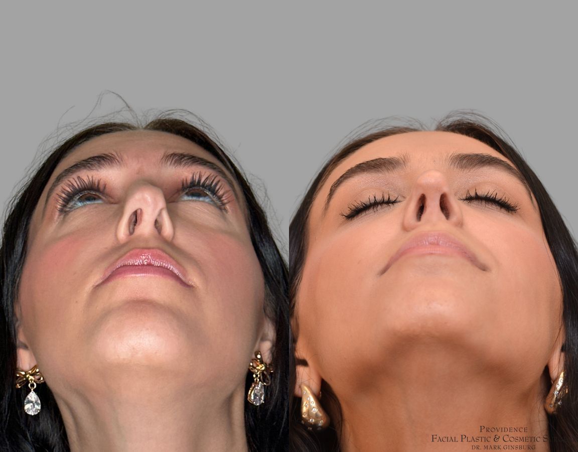 Before and after Revision Rhinoplasty case 43678 - Angle 7