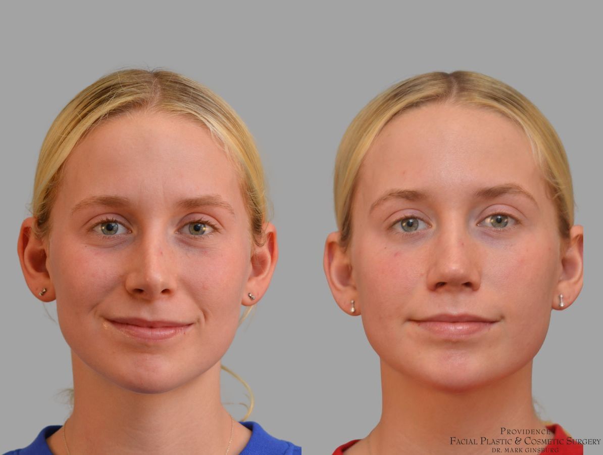 Before and after Revision Rhinoplasty case 41761 - Angle 3