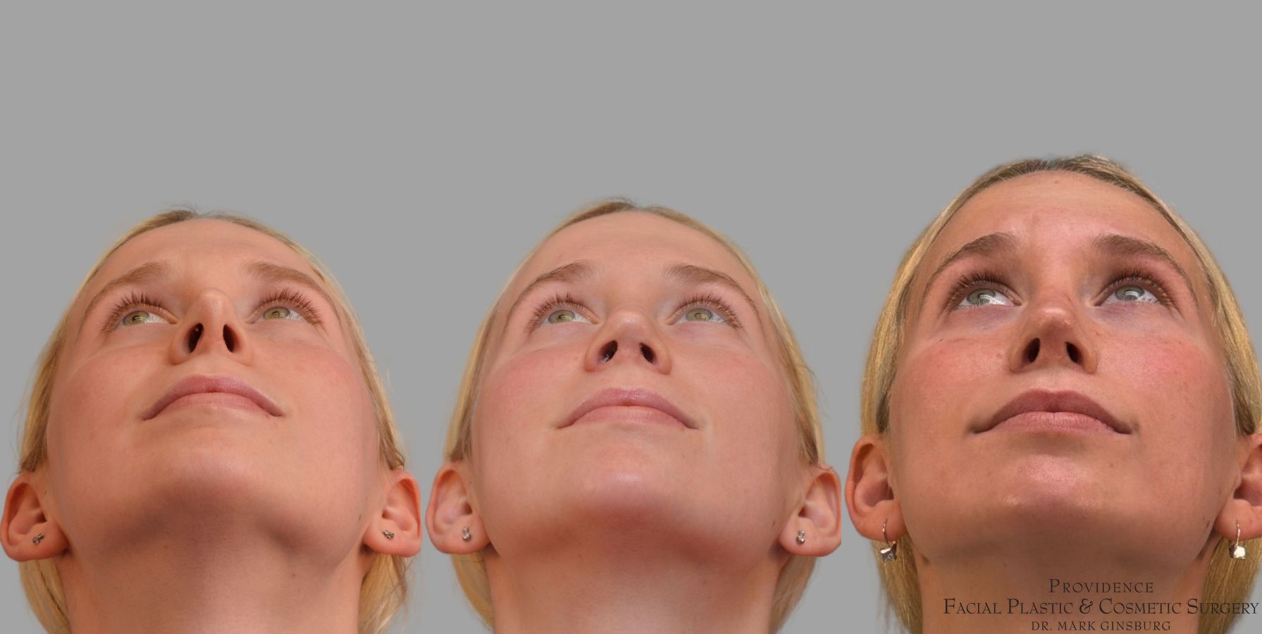 Before and after Revision Rhinoplasty case 41761 - Angle 6