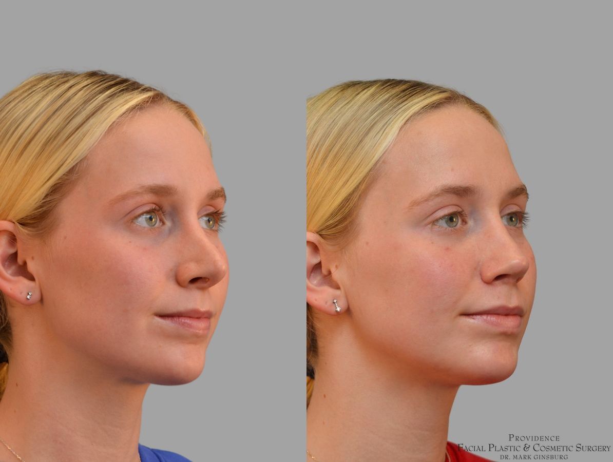 Before and after Revision Rhinoplasty case 41761 - Angle 4