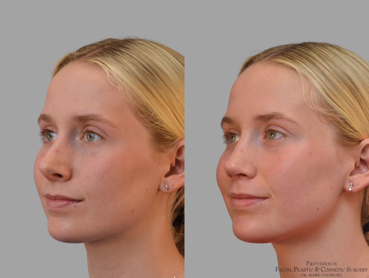 Before and after Revision Rhinoplasty case 41761 - Angle 2