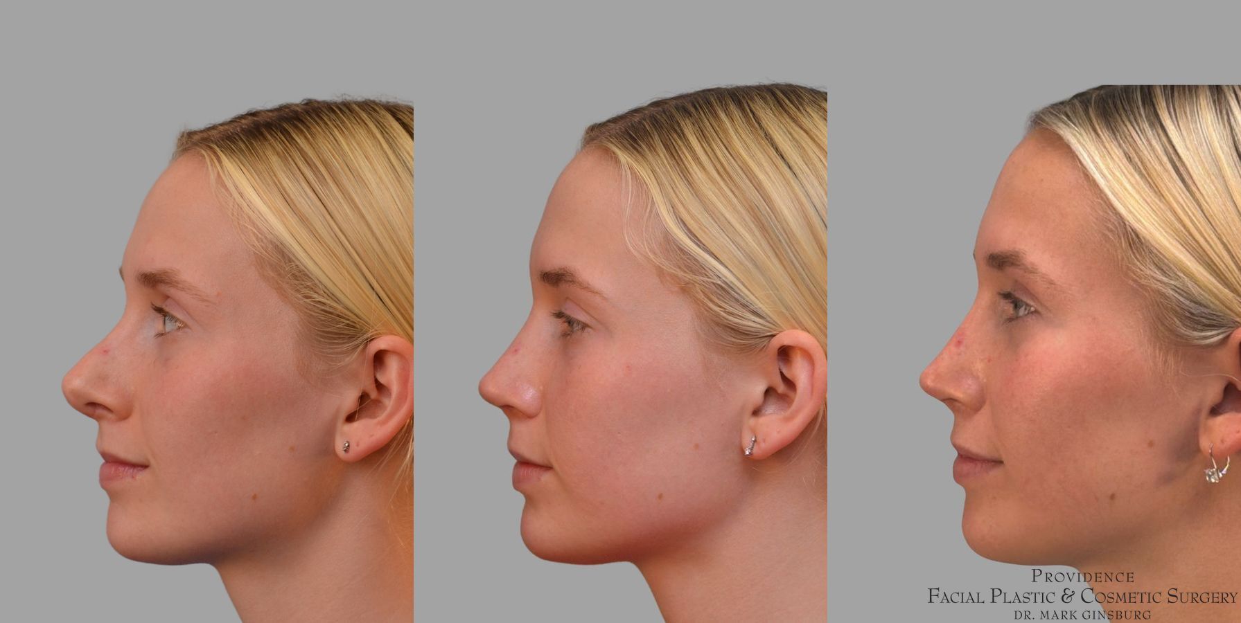Before and after Revision Rhinoplasty case 41761