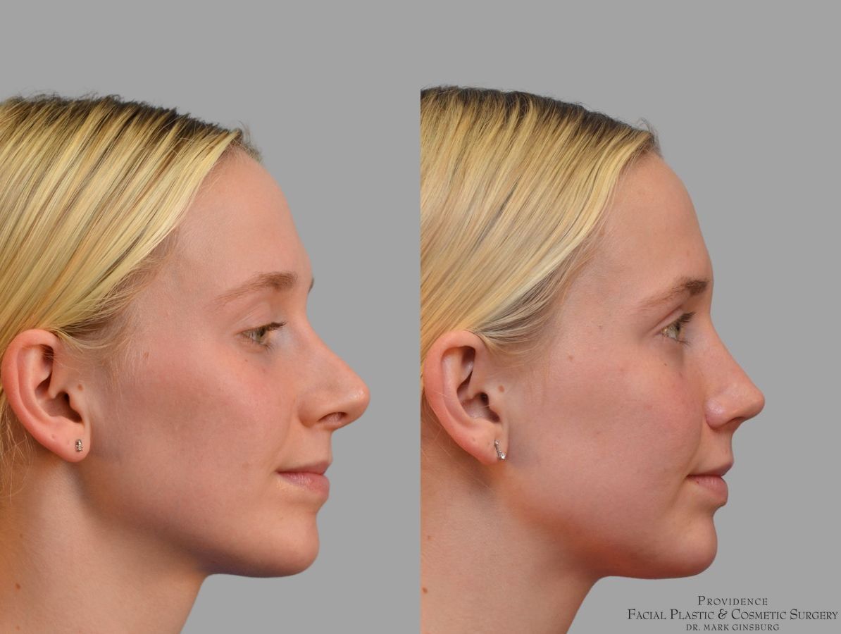 Before and after Revision Rhinoplasty case 41761 - Angle 5